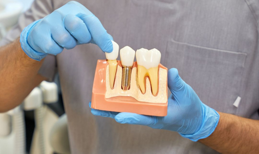 Choose Dental Implants for Long-Lasting Dental Restoration