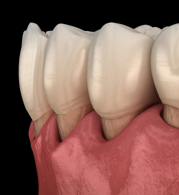 Periodontal Cleaning St. Charles IL