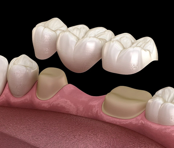 Dental Crowns and Bridges St. Charles IL