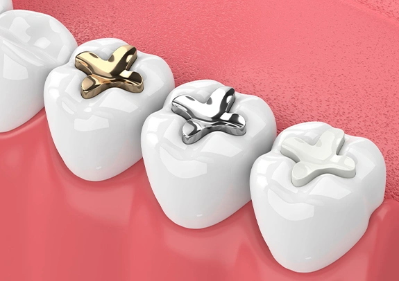 Dental Fillings St. Charles IL