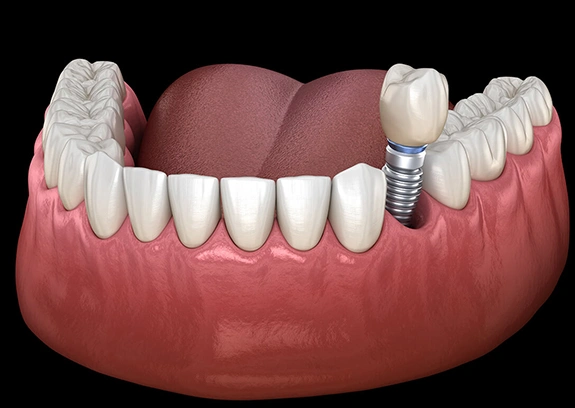 Dental Implants St. Charles IL