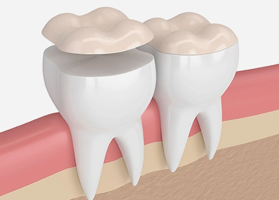 Inlays & Onlays St. Charles IL