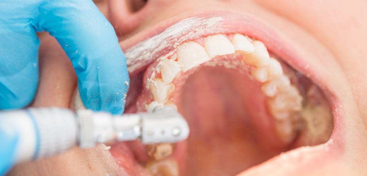 How Often Should You Get A Dental Cleaning? Insights From A Dentist