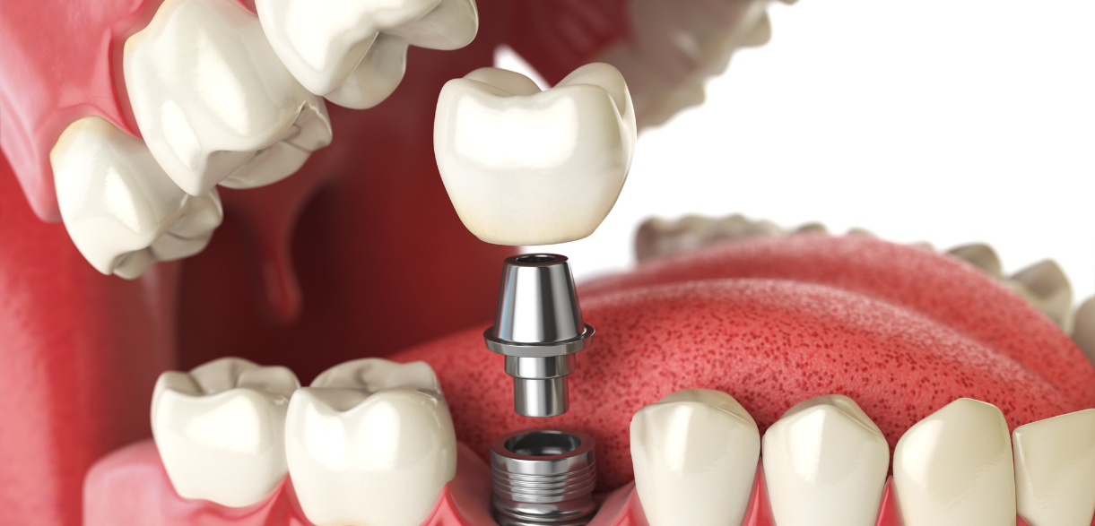Is Bruxism a Barrier to Getting Dental Implants?