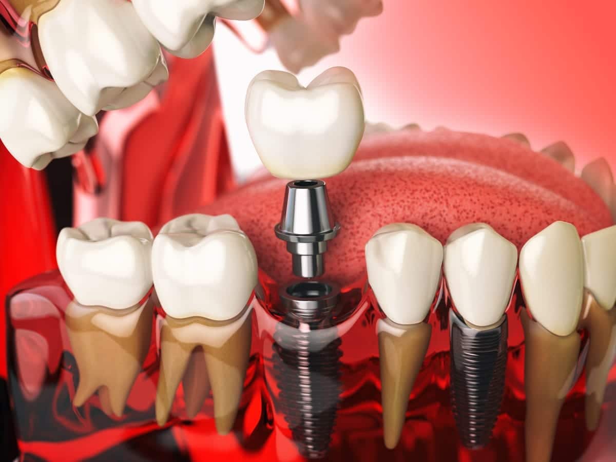 Dental Implants in Farmington