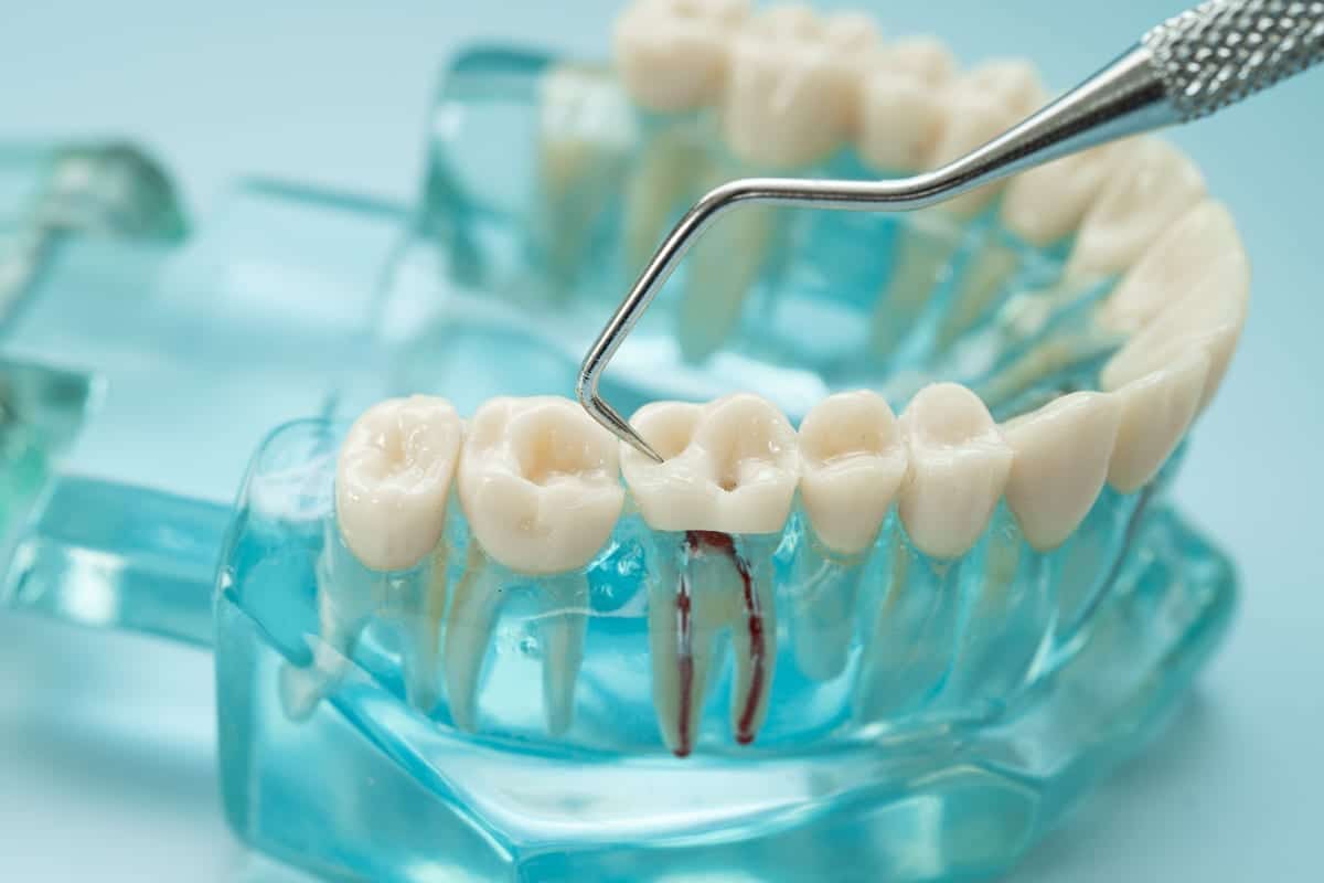 Root Canal Treatment in St. Charles